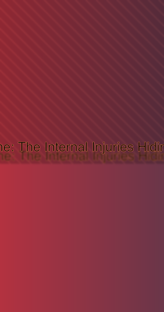 Seat Belt Syndrome: The Internal Injuries Hiding Behind a Bruise